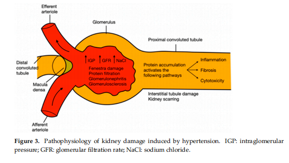 Pathophysiology of kidney damage induced by hypertension. IGP: intraglomerular pressure; GFR: glomerular filtration rate; NaCl: sodium chloride